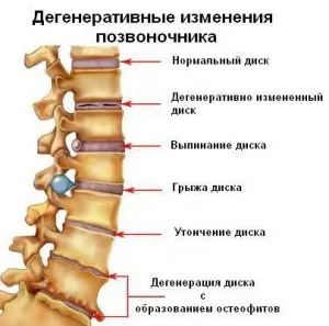як лікувати остеохондроз 4 ступеня
