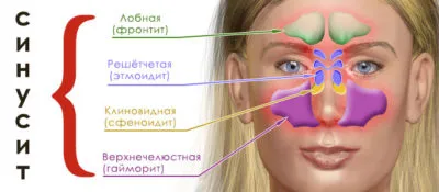 лікувати синусит будинку