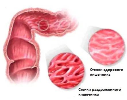 як лікувати роздратований шлунок