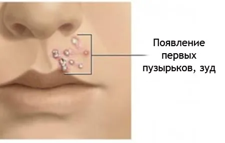 як лікувати стрептодермії при вагітності