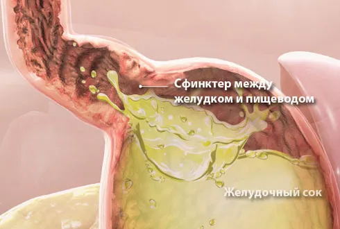 як лікувати печію содою