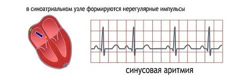 помірна синусова аритмія