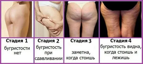 як лікувати 4 стадію целюліту