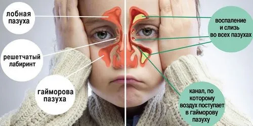 синусит