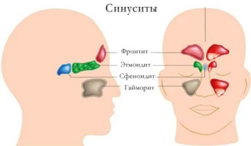 Синусит при вагітності: чим лікувати синусит вагітність лікування