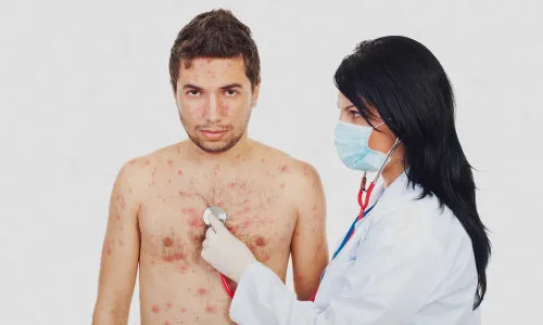 як лікувати висип при вич