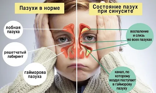 як лікувати синусит у дітей