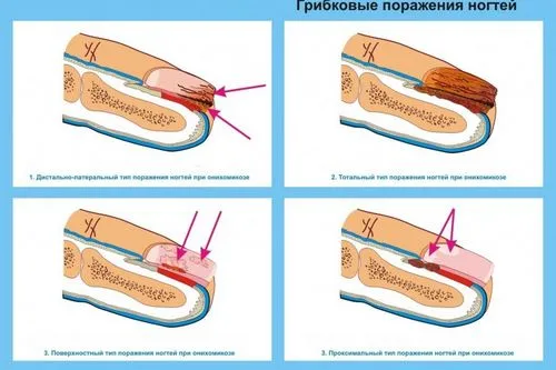 як вилікувати грибок нігтів перекисом водню