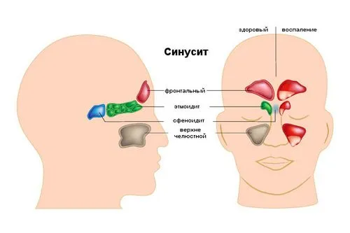 ніж лікувати синусит у дорослих