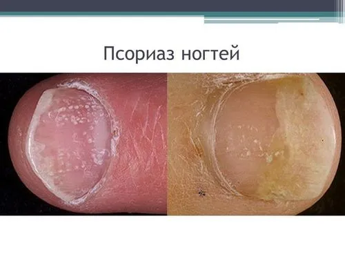 як вилікувати грибок нігтів перекисом водню