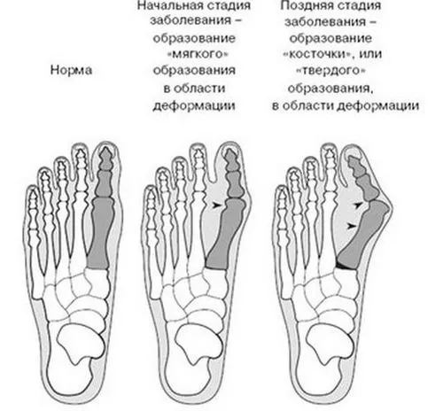 бурсит великого пальця стопи фото