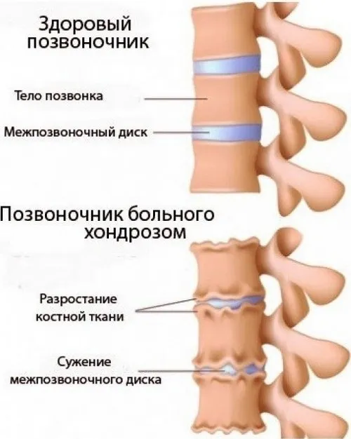як лікувати хондроз попереку