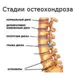 вправи для шиї при шийному остеохондрозі