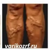 як лікувати варикоз і тромбофлебіт