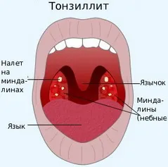 Тонзиліт у дитини - симптоми, профілактика та лікування як лікувати тонзиліт дітям