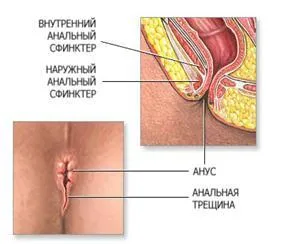 як лікувати геморой тріщини