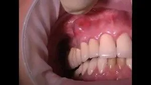 як лікувати гнійник на яснах у дитини