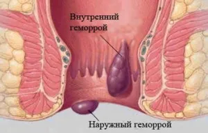 як лікувати геморой тріщини