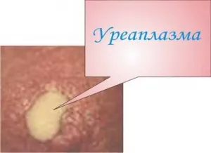 чи можна вилікувати уреаплазму Гексикон