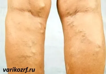 як лікувати варикоз і тромбофлебіт