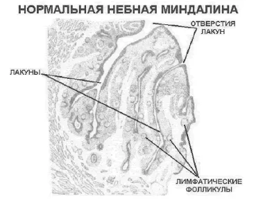 лікування тонзиліту з гнійними пробками