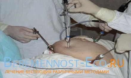 як вилікувати трубне безпліддя