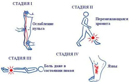 трофічна виразка на нозі