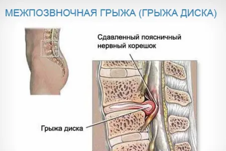 як лікувати защемлення нервів в хребті