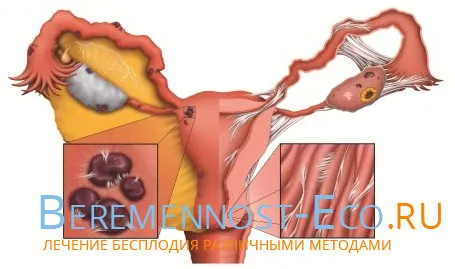 трубно перитонеальне безпліддя лікування