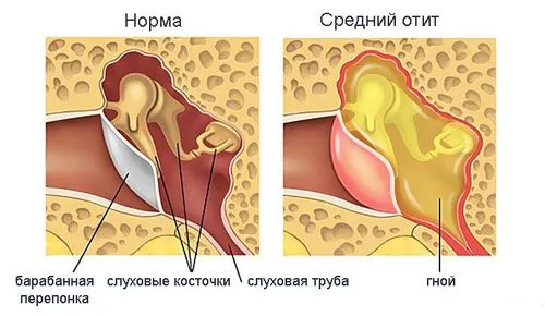 болить вухо у дитини перша допомога