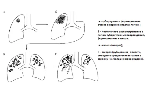 як лікувати туберкулема легких