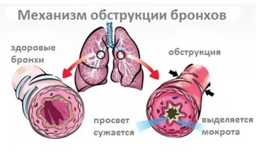 як лікувати туберкулема легких