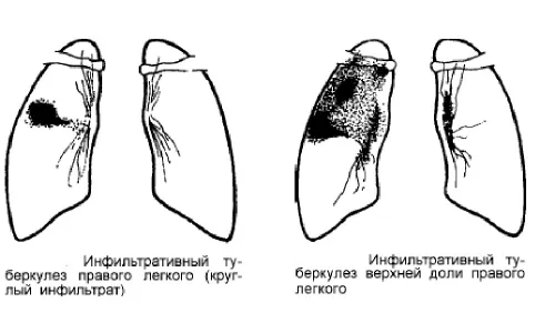як лікувати туберкулема легких