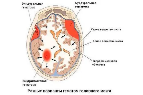 як швидко лікувати забій голови