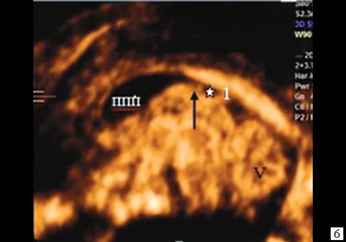 hall-riggs syndrome