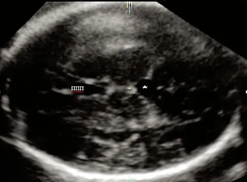 cavum septum pellucidum