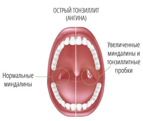 лікування тонзиліту з гнійними пробками