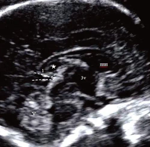hall-riggs syndrome