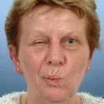 як лікувати невралгію лицьового нерва в домашніх умовах