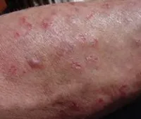як лікувати хламідіоз у жінок і чоловіків
