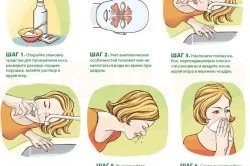 як лікувати вазомоторний риніт у дитини