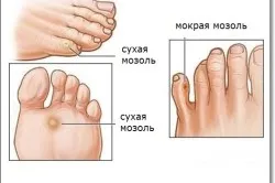 як лікувати мокнучу мозоль