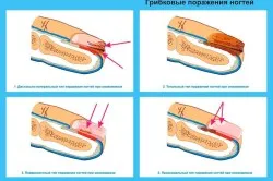 як лікувати нерівні нігті