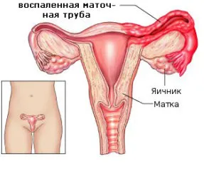 як лікувати хламідіоз жінкам