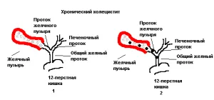 як лікувати холецистит печінки