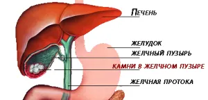 синдроми що таке холецистит бескаменний некалькульозний хронічний лікування печінку ознаки урсодезоксихолевої кислоти постхолецистектомічний препарати урсодезоксихолевої кислоти урсодезоксихолевої