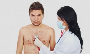 лікувати вітрянку дорослому