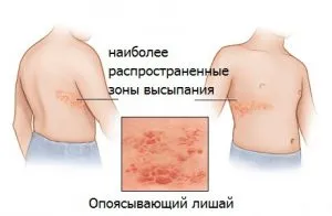 як лікувати вітрянку дітям до року