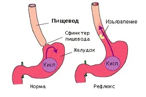 відчуття печіння на мові