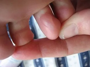 лікувати водяний мозоль